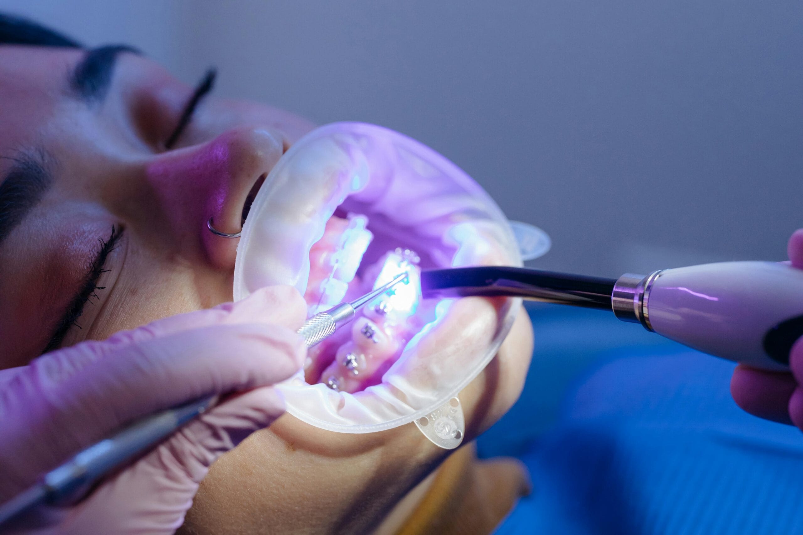 Close-up of a dental procedure using LED light curing for treatment.
